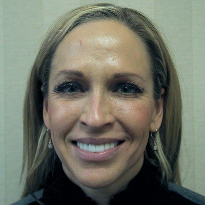 One of Dr. Bjorklund', a dentist in Wayzata MN, actual patients after her dental treatment.